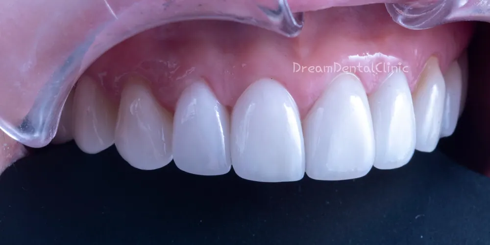 Làm lại Veneer do viêm nướu vì mài răng quá mức — ảnh 5
