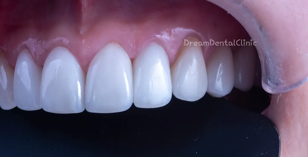Làm lại Veneer do viêm nướu vì mài răng quá mức — ảnh 6