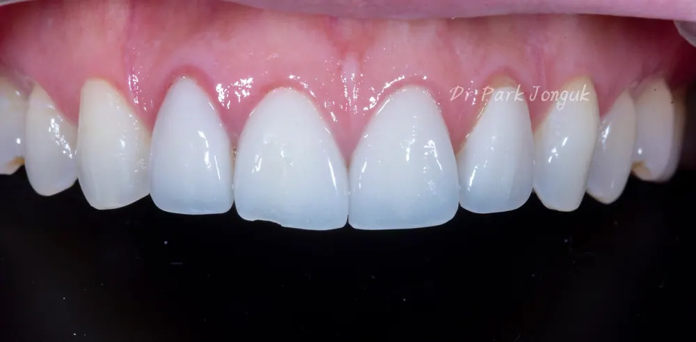 Điều luôn khiến tôi bất ngờ khi làm lại Veneer — ảnh 1
