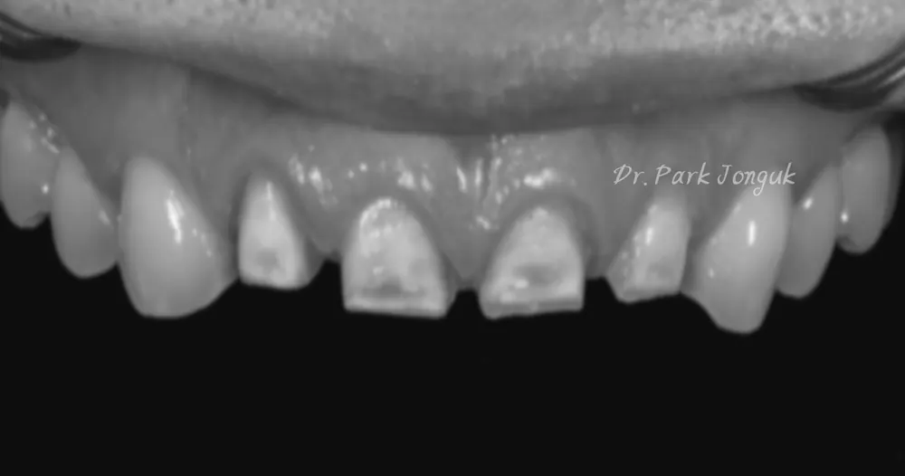 Điều luôn khiến tôi bất ngờ khi làm lại Veneer — ảnh 2