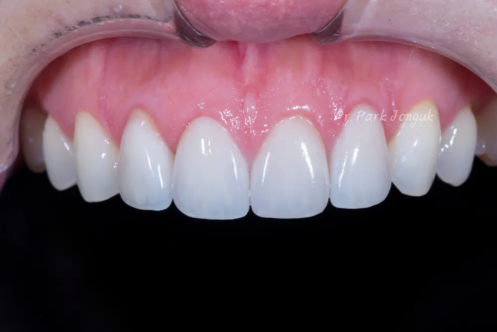 Điều luôn khiến tôi bất ngờ khi làm lại Veneer — ảnh 3