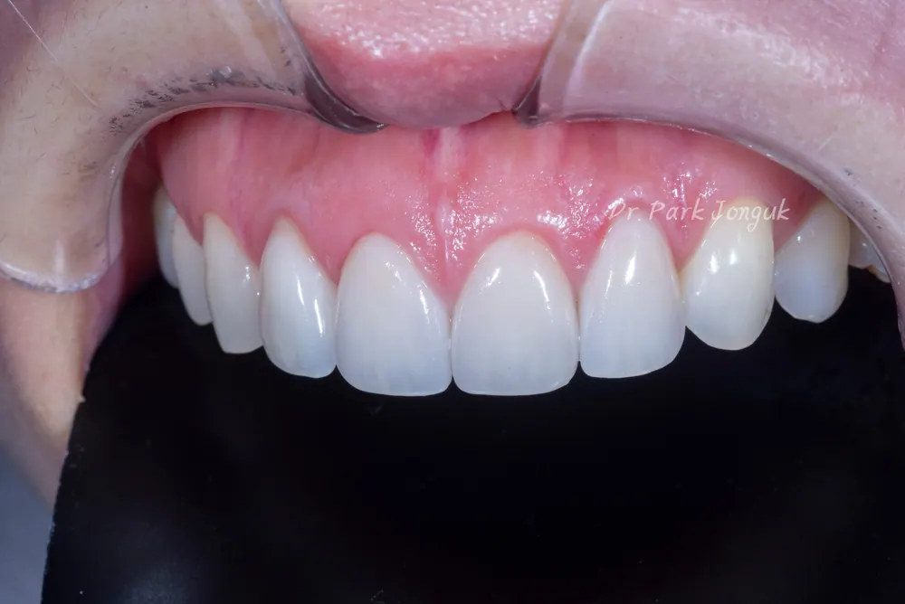 Điều luôn khiến tôi bất ngờ khi làm lại Veneer — ảnh 4