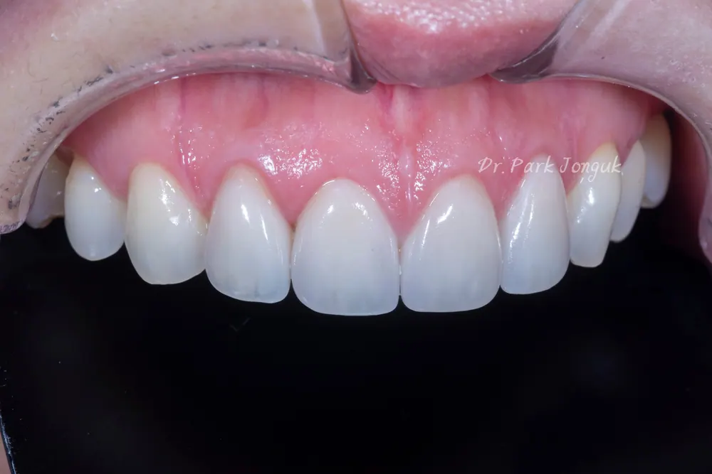 Điều luôn khiến tôi bất ngờ khi làm lại Veneer — ảnh 5