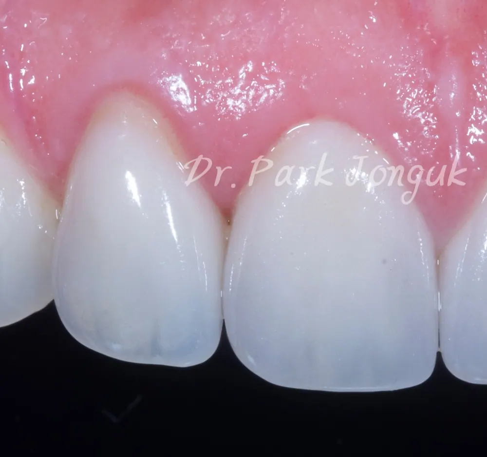 Điều luôn khiến tôi bất ngờ khi làm lại Veneer — ảnh 6