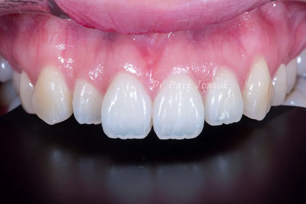 Veneer tính đến cả cách sắp xếp răng — ảnh 1