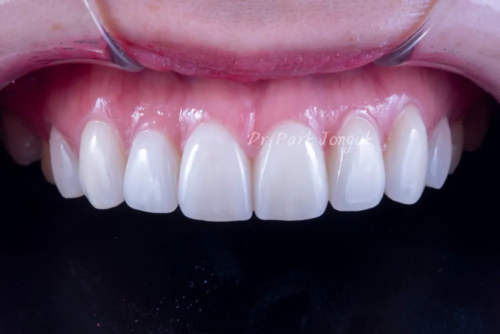 Veneer tính đến cả cách sắp xếp răng — ảnh 2