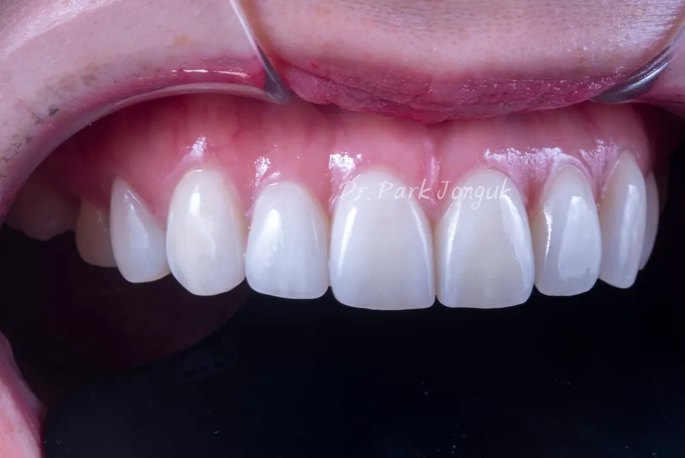 Veneer tính đến cả cách sắp xếp răng — ảnh 3