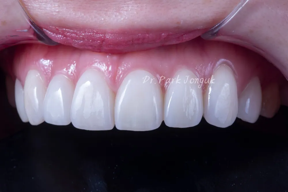 Veneer tính đến cả cách sắp xếp răng — ảnh 4