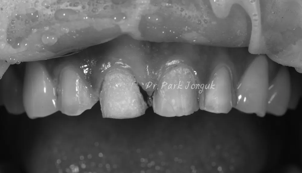ラミネートベニアの再治療で必ず守るべきポイント — 写真3