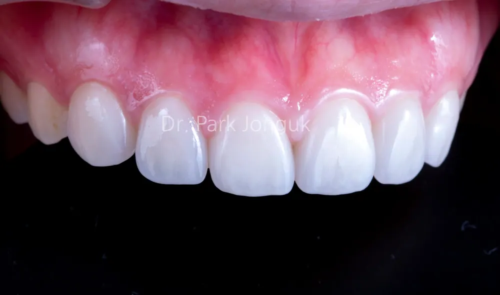 陶瓷貼片重做 — 圖4