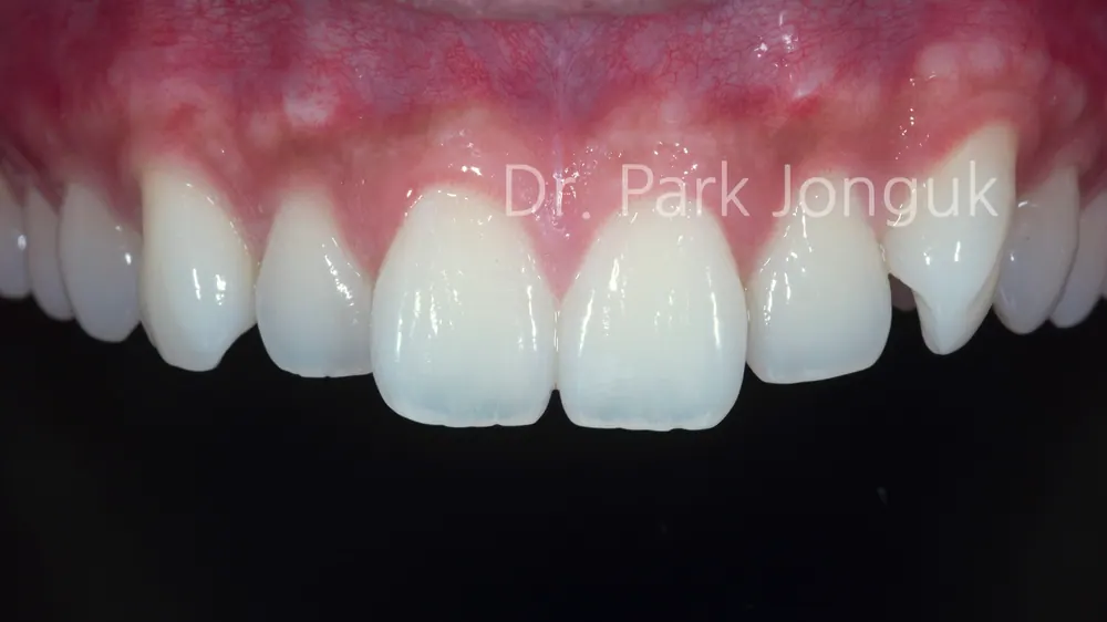 Quy trình dán sứ Veneer răng cửa cho phép xem trước cả lượng mài răng — ảnh 1