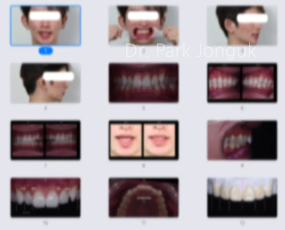 Quy trình dán sứ Veneer răng cửa cho phép xem trước cả lượng mài răng — ảnh 2