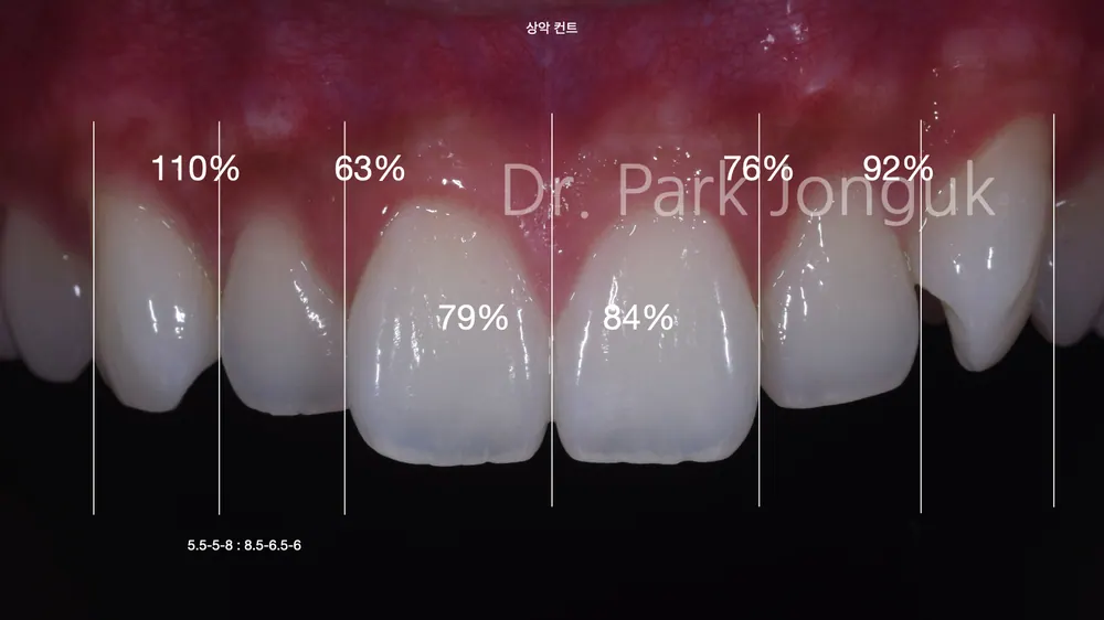 Quy trình dán sứ Veneer răng cửa cho phép xem trước cả lượng mài răng — ảnh 3