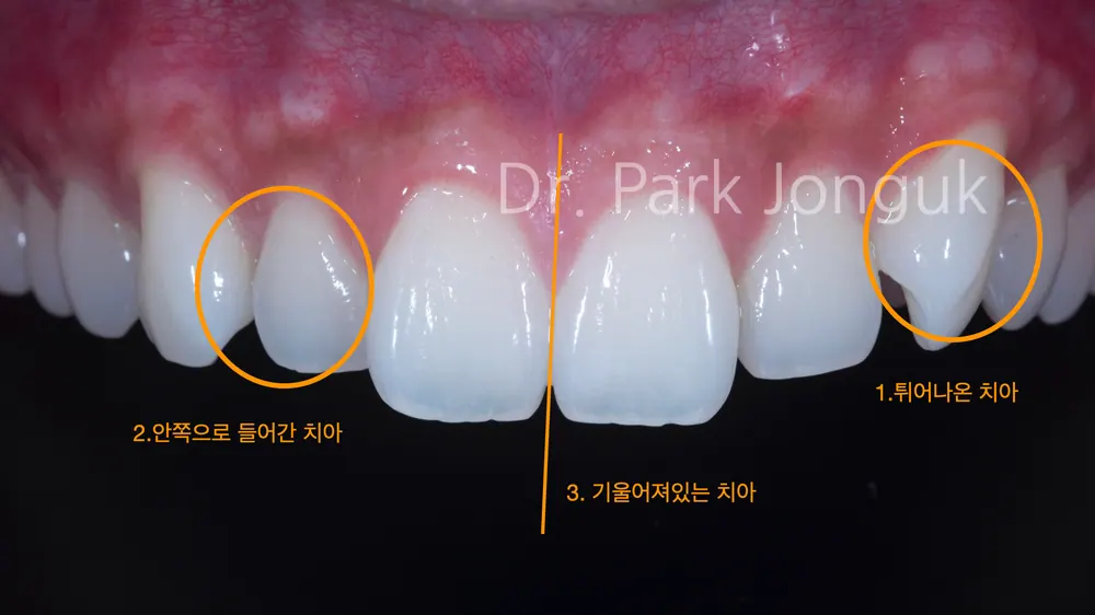 Quy trình dán sứ Veneer răng cửa cho phép xem trước cả lượng mài răng — ảnh 4