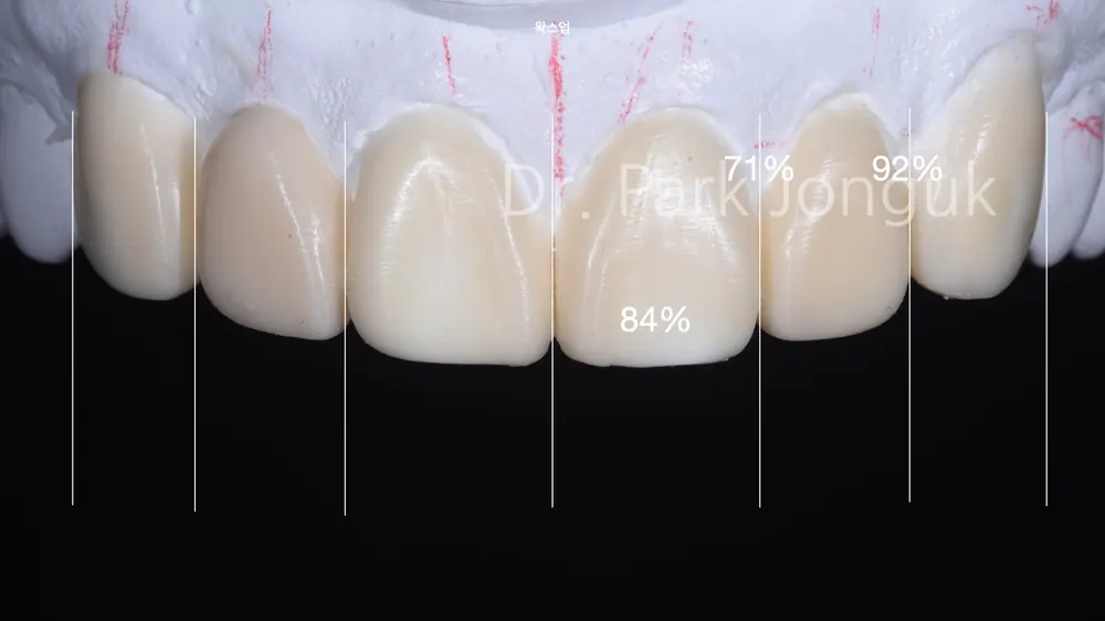 Quy trình dán sứ Veneer răng cửa cho phép xem trước cả lượng mài răng — ảnh 5