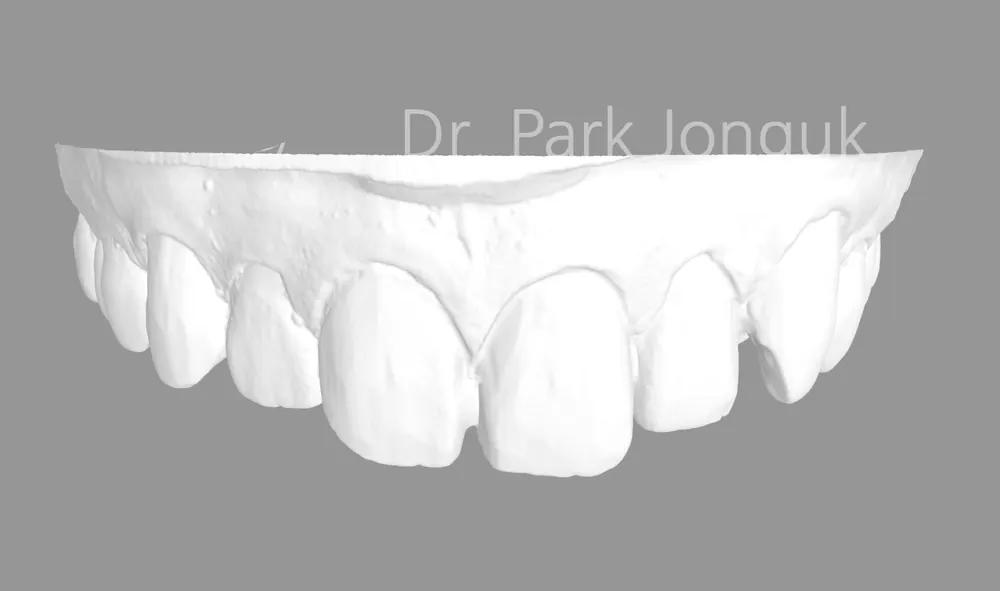 Quy trình dán sứ Veneer răng cửa cho phép xem trước cả lượng mài răng — ảnh 6