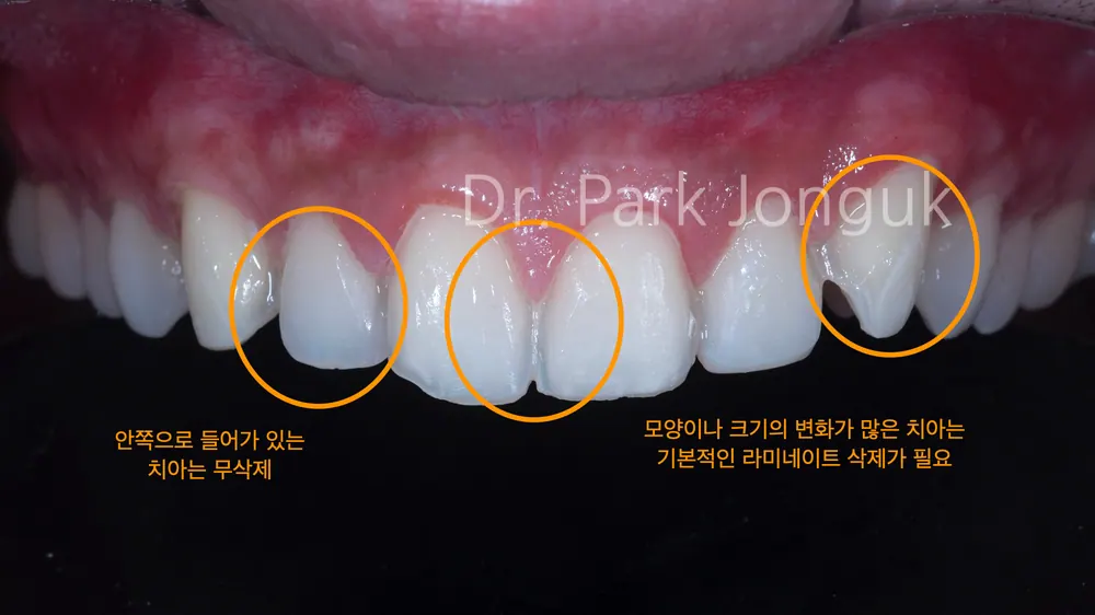 Quy trình dán sứ Veneer răng cửa cho phép xem trước cả lượng mài răng — ảnh 7