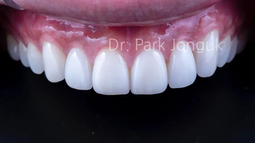 Quy trình dán sứ Veneer răng cửa cho phép xem trước cả lượng mài răng — ảnh 8