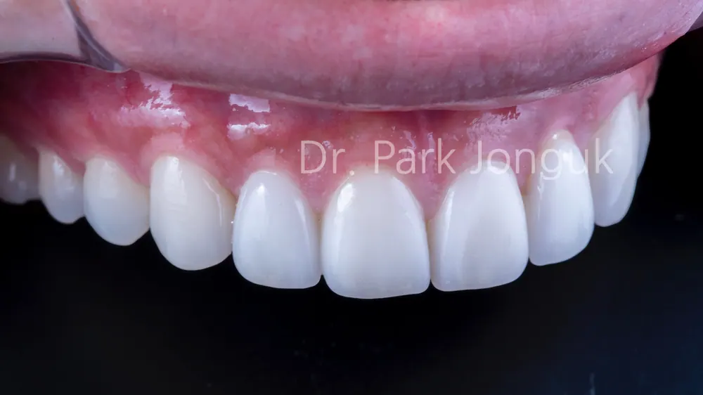 Quy trình dán sứ Veneer răng cửa cho phép xem trước cả lượng mài răng — ảnh 9