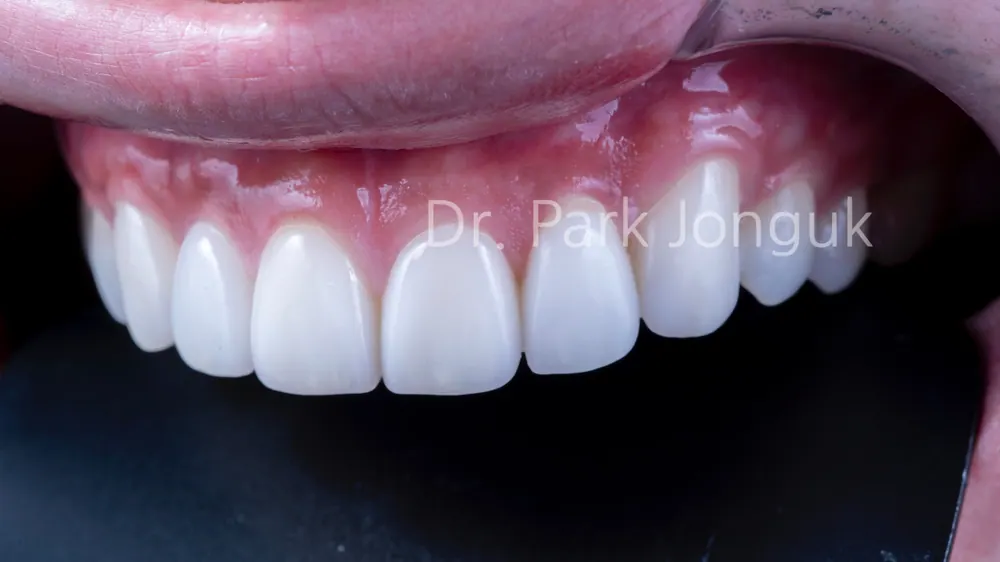 Quy trình dán sứ Veneer răng cửa cho phép xem trước cả lượng mài răng — ảnh 10