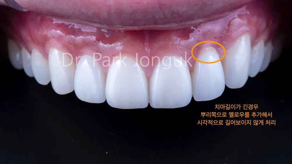 Quy trình dán sứ Veneer răng cửa cho phép xem trước cả lượng mài răng — ảnh 12