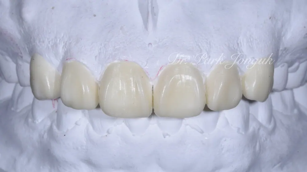 削らないラミネートベニアで、副作用は減らし寿命は延ばす方法 — 写真2