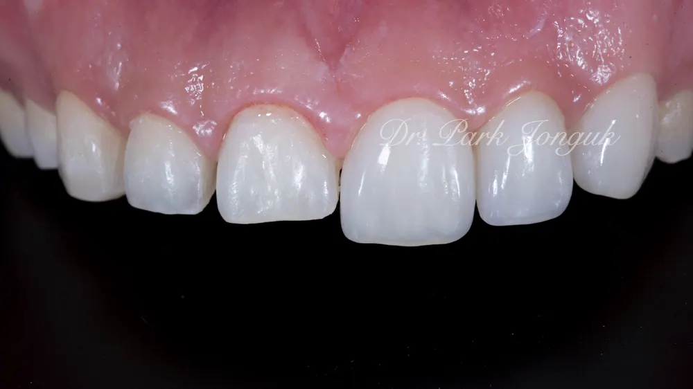 削らないラミネートベニアで、副作用は減らし寿命は延ばす方法 — 写真6