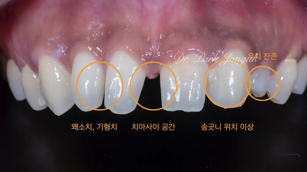 การทำฟันสวยงามด้วยวีเนียร์ที่เปลี่ยนแปลงอย่างน่าทึ่งแต่ยังคงความเป็นธรรมชาติ — ภาพที่ 2