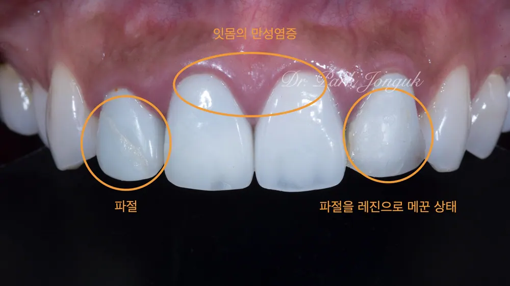 압구정동치과추천 오래된 올세라믹 크라운의 리메이크 본문 사진 2