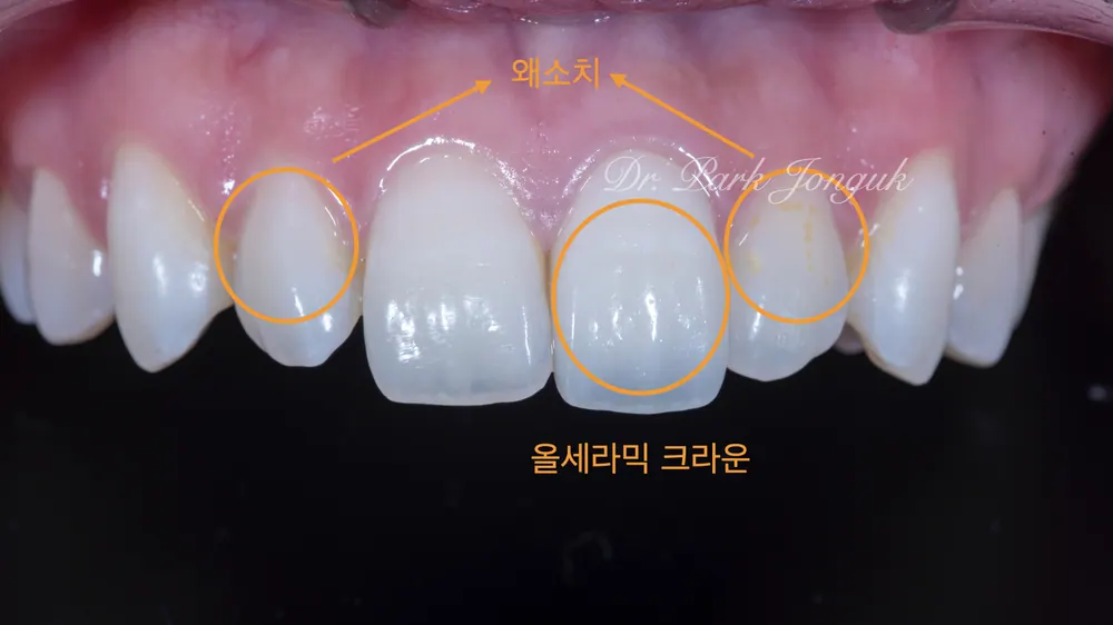 狎鷗亭站牙科推薦：全瓷冠重新治療與過小牙治療 — 圖2