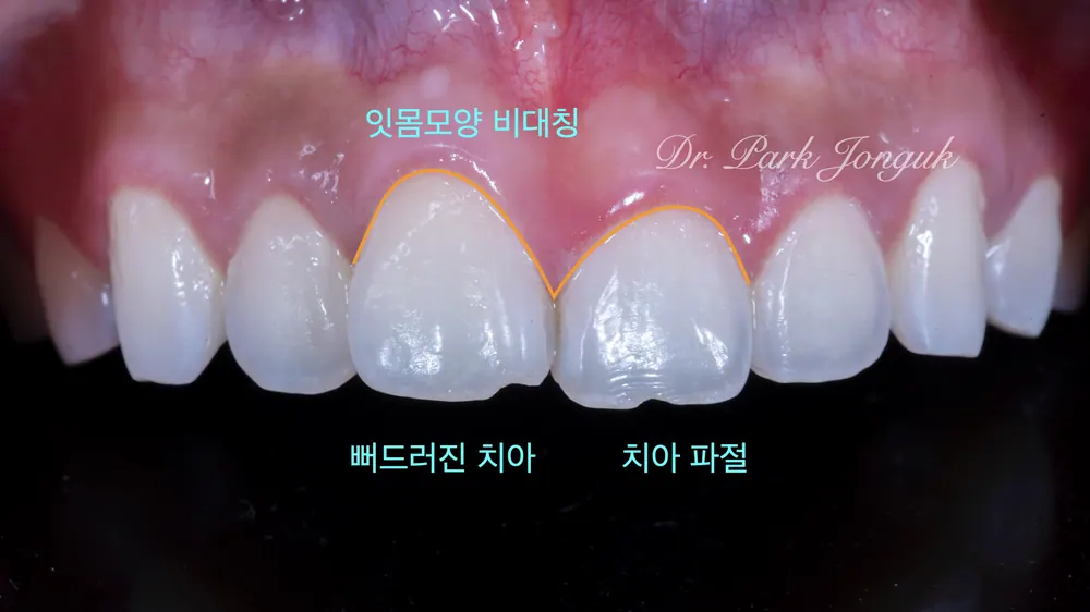 강남라미네이트잘하는치과 뻐드러진 치아의 라미네이트 본문 사진 3