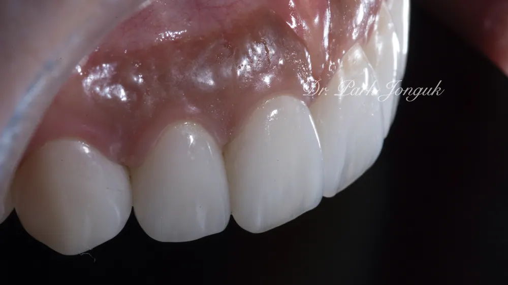 ソウルでラミネートが上手な歯科医院 自然な仕上がりがポイント — 写真8