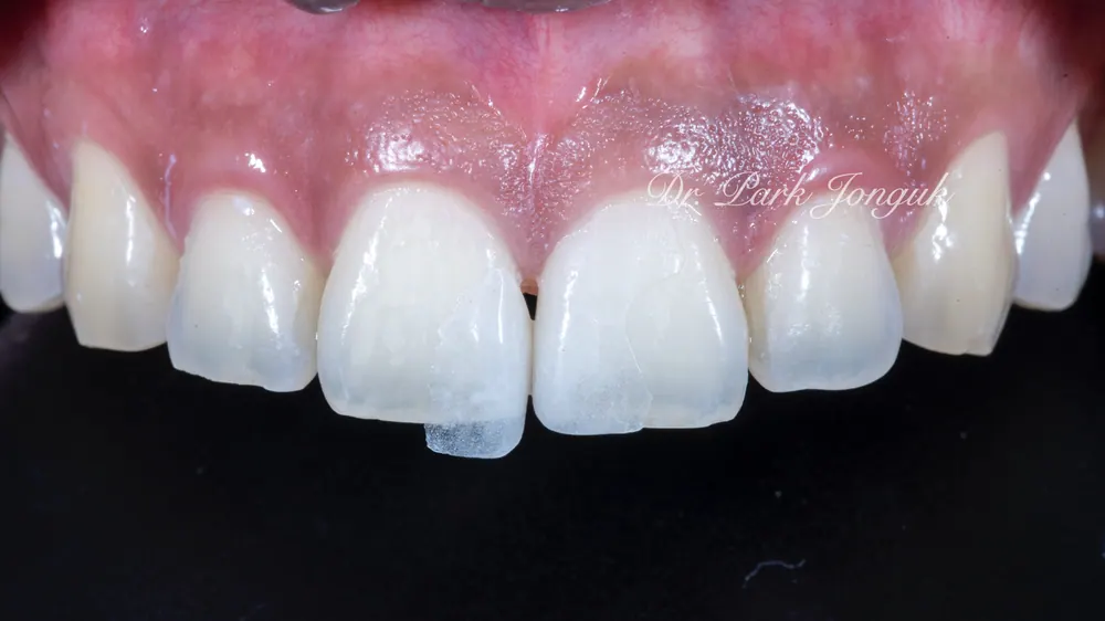 Ca lâm sàng Veneer bán phần không mài răng cho răng thưa — ảnh 4
