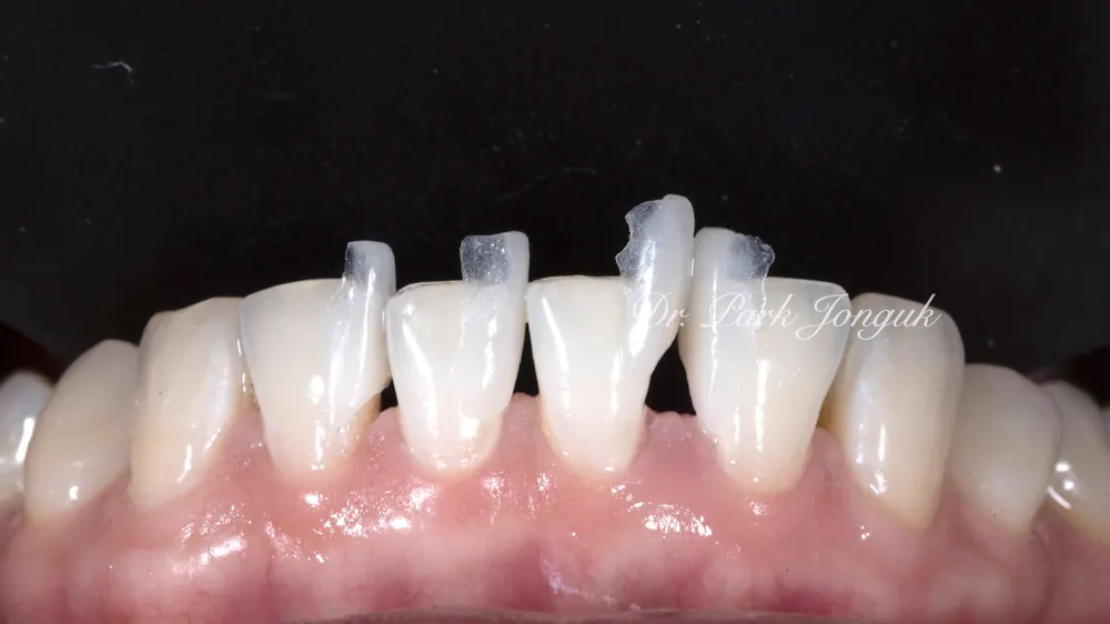 Ca lâm sàng Veneer bán phần không mài răng cho răng thưa — ảnh 7