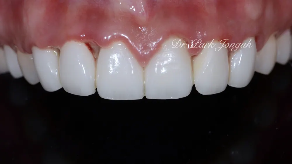 Veneer Redo: A Case with Severe Gum Inflammation — photo 1