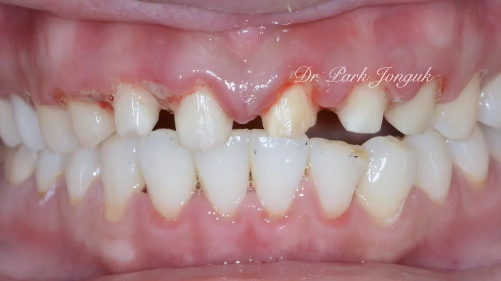 Veneer Redo: A Case with Severe Gum Inflammation — photo 2