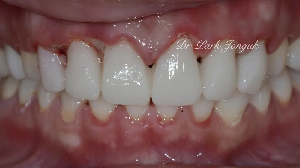 Veneer Redo: A Case with Severe Gum Inflammation — photo 3
