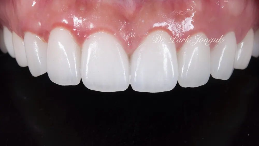 Veneer Redo: A Case with Severe Gum Inflammation — photo 6