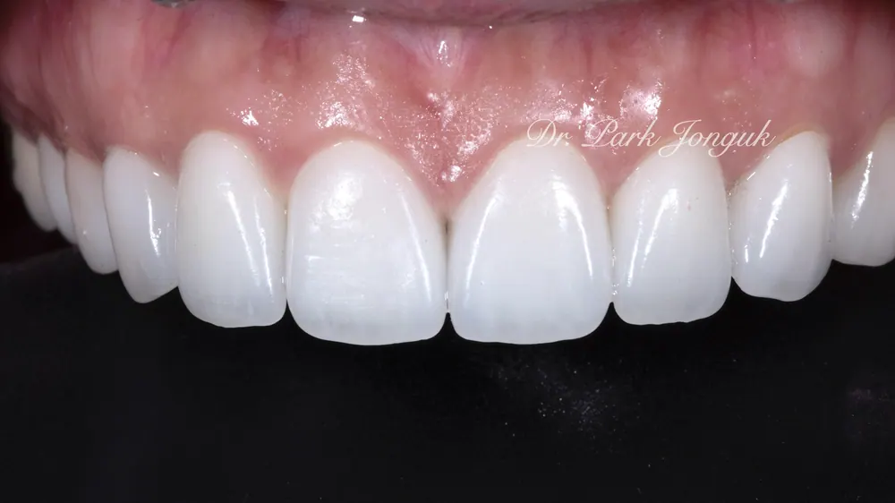 Veneer Redo: A Case with Severe Gum Inflammation — photo 7