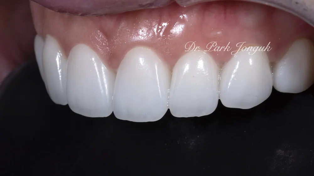 Veneer Redo: A Case with Severe Gum Inflammation — photo 9