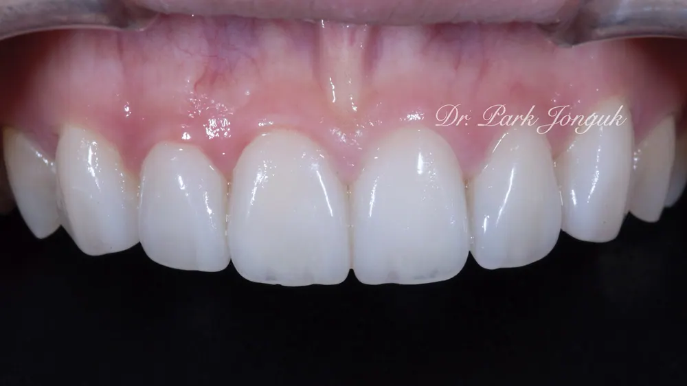 Nha khoa dán sứ Veneer uy tín - Điểm mấu chốt là vẻ đẹp và sự tự nhiên — ảnh 2