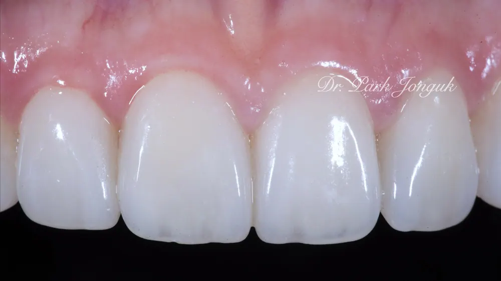 Nha khoa dán sứ Veneer uy tín - Điểm mấu chốt là vẻ đẹp và sự tự nhiên — ảnh 3