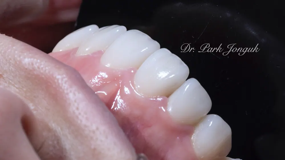 Nha khoa dán sứ Veneer uy tín - Điểm mấu chốt là vẻ đẹp và sự tự nhiên — ảnh 4