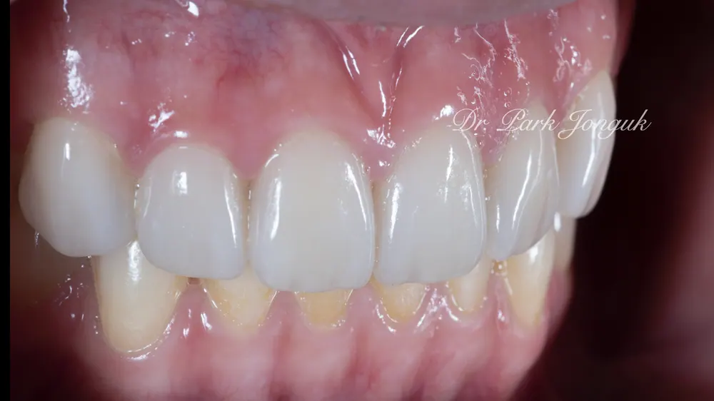 Nha khoa dán sứ Veneer uy tín - Điểm mấu chốt là vẻ đẹp và sự tự nhiên — ảnh 6