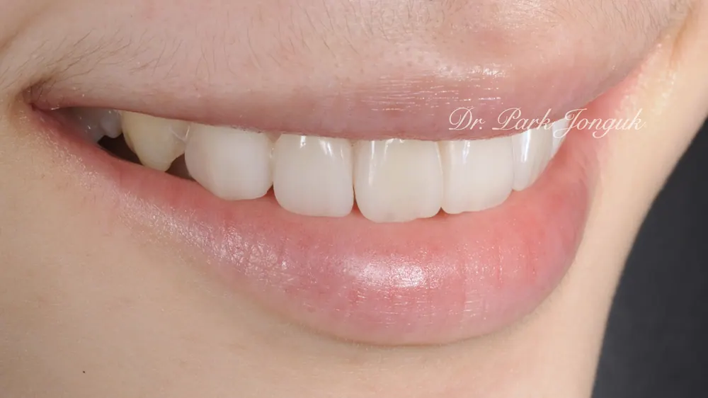 Nha khoa dán sứ Veneer uy tín - Điểm mấu chốt là vẻ đẹp và sự tự nhiên — ảnh 7