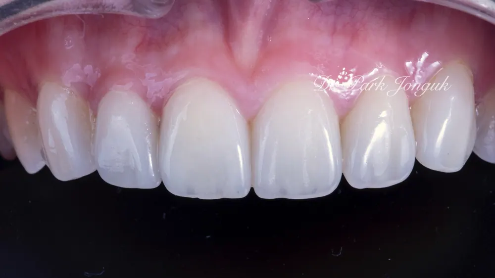 Nha khoa dán sứ Veneer uy tín - Điểm mấu chốt là vẻ đẹp và sự tự nhiên — ảnh 8