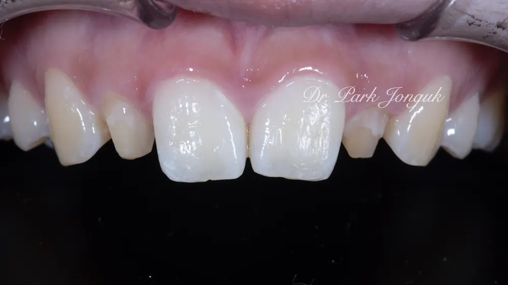 Veneer cho răng to: Răng to vẫn OK — ảnh 1
