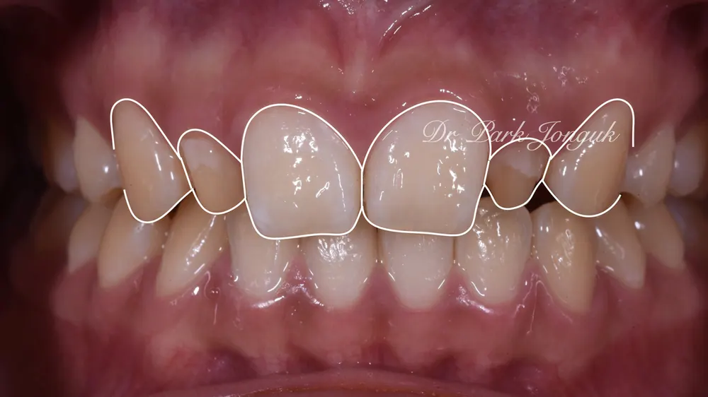 Veneer cho răng to: Răng to vẫn OK — ảnh 2