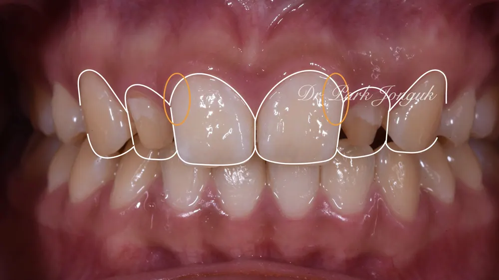 Veneer cho răng to: Răng to vẫn OK — ảnh 3