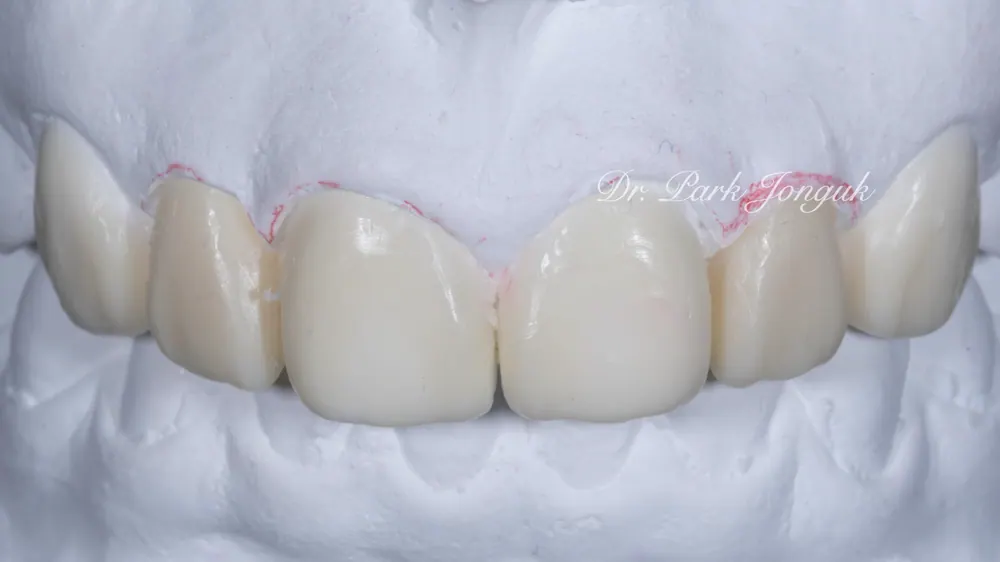 Veneer cho răng to: Răng to vẫn OK — ảnh 4